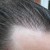 rsz_front_hairline