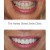 Replacement Veneers 1