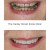 Replacement Veneers 5