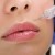 Dermal Fillers